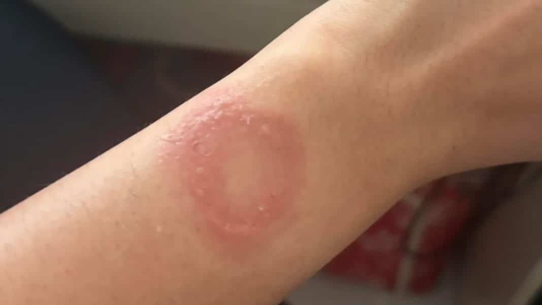 Apple Watch teria causado queimadura e usuário relata descaso da Apple Watch teria causado queimadura e usuário relata descaso da fabricante